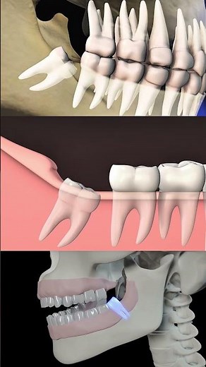 Wisdom tooth eruption — gum tissue overlapping the crown, pain, inflammation. Pericoronitis.