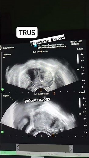 TRI PLANE TRUS Probe for specialized Prostate Biopsy. #ProstateHealth #MedicalTechnology #Urology