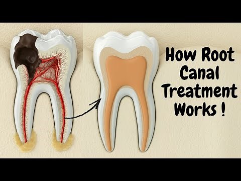 Afraid of Root Canal? Here’s What Really Happens!