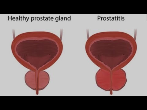 Prostate - exercises Episode 1