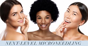 Vivace™ Microneedling with Radio Frequency