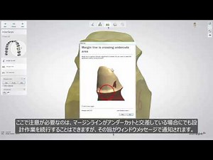 3Shape Dental System - フルアナトミカルクラウンを設計する方法