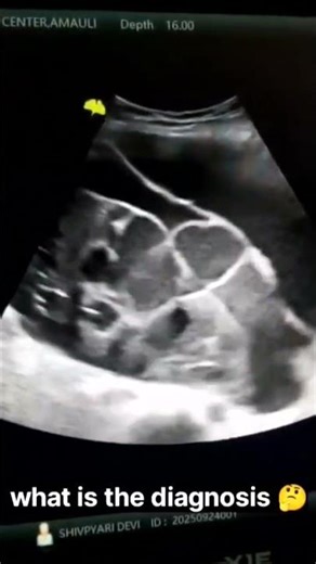 Female patient age 50 years lower abdomen severely pain and severely fever #ultrasound #viral #cyst