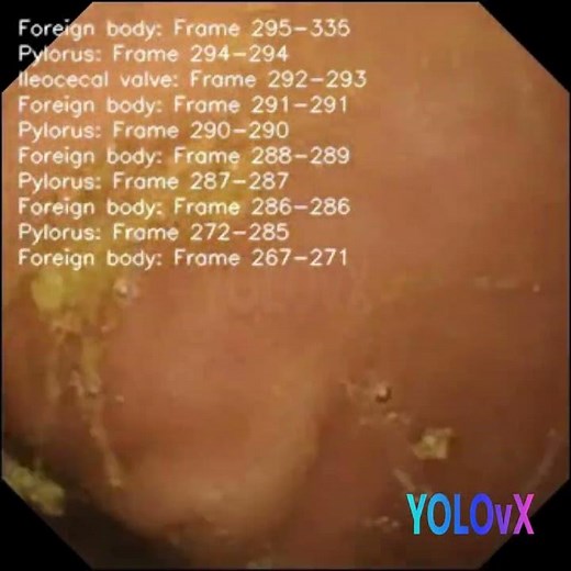 What is happening inside stomach: AI-Powered Capsule Endoscopy 🚀