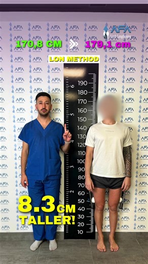 8,3 CM TALLER ! LON METHOD #afalimblengthening #heightincreasesurgery #heightincrease #limblengtheningsurgeryturkey #limblengthening #limblenghteningsurgery #limblenghteningsurgery #legslengthening #keşfet #usingtiktok #tiktok #gettaller #keşfetteyizzz