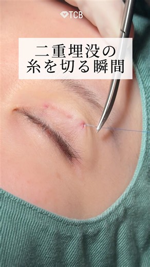 [Double Eyelid Surgery] The Moment the Thread is Cut in a Double Eyelid Burial Procedure! #shorts