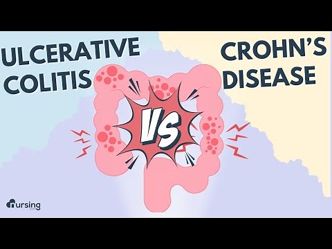 Inflammatory Bowel Disease- Ulcerative Colitis vs. Crohn's Disease