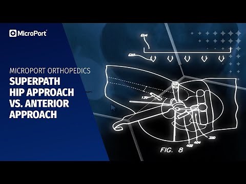 SuperPath Hip Approach vs. Anterior Approach