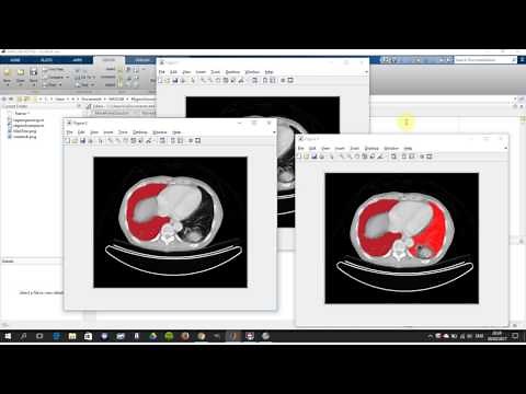 Region Growing. Segmentation by growing a region from seed point in Matlab