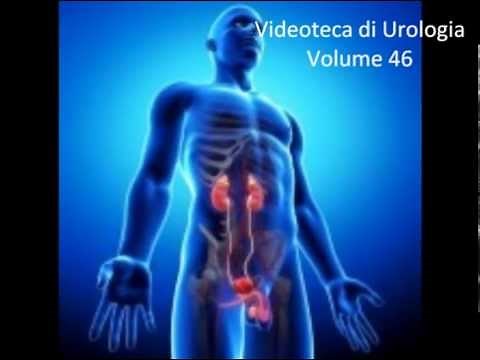 Cisti dell'epididimo. Video di Urologia e Andrologia . www.urologia-andrologia.net