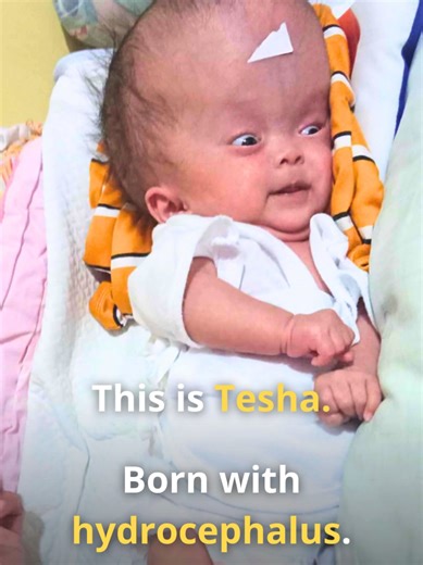 I still remember when Tesha’s mom first reached out. Her baby’s head kept growing. Doctors warned surgery was risky. All she could do was wait… and hope. Tesha was born with hydrocephalus. Surgery was her only chance. You said yes. Today, Tesha is 2 years old. Her mom just sent us this update: “She’s happy. She can stand. And when I hold her hand… she walks.” She’s still learning. Still growing. But she’s here, because you showed up. This is what hope looks like, two years later. #MayasHope #Tog