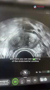 Recurrent Miscarriage Cause Found On 3D Ultrasound! | Mamata Fertility Hospital: Hyderabad