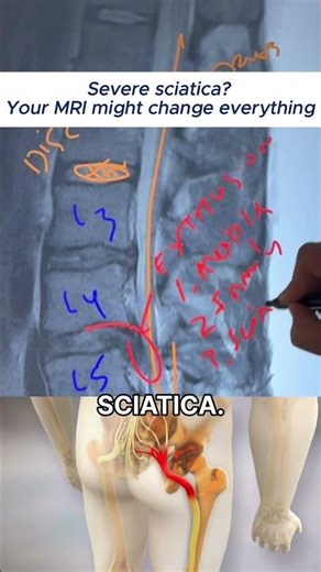 How Spinal Decompression Helped Severe Sciatica Without Surgery | Back Pain Relief