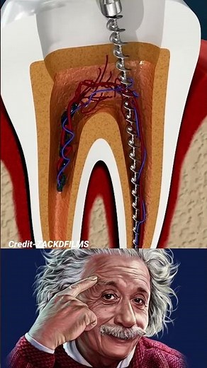 Inside the Root Canal: Treating Tooth Nerve Infections