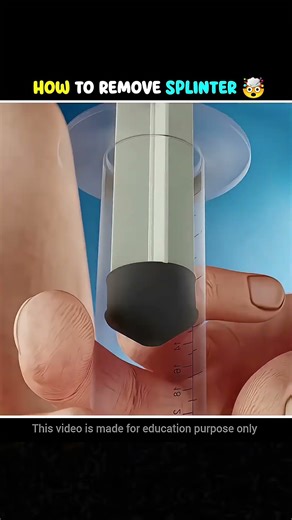 Home remedy to remove thorns.