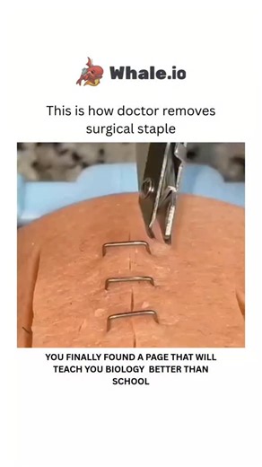Medical on Instagram: "A doctor removes surgical staples using a sterile staple extractor tool, a device designed to gently lift the staple's ends and apply inward pressure, causing it to open and slide out of the skin. The area is first cleaned, and the doctor places the lower jaw of the tool under the staple, squeezes the handles, and wiggles it to release the staple, which is then placed on gauze Dm for credit or removal🙏 For educational purposes only...... #viral #explore #science #k