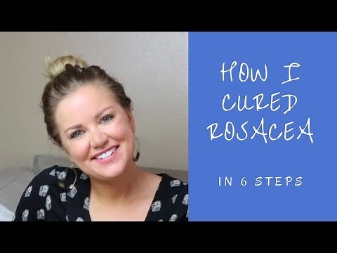 How I Cured Rosacea For Good! - 6 Steps