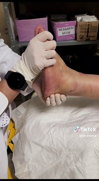 Dislocated Ankle Adjustment Compilation