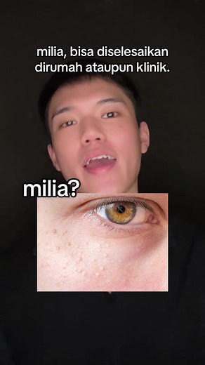 Understanding Milia: Causes, Treatment, and Prevention