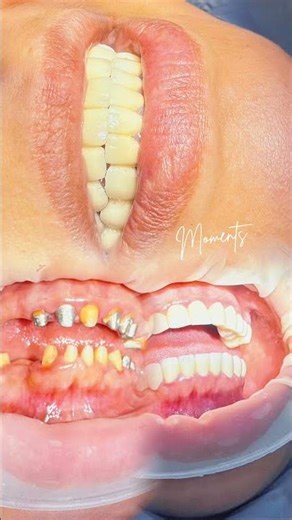 Destroyed Teeth to Perfect Smile | Full Mouth Crown Transformation