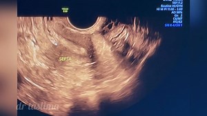 33K views · 326 reactions | TVS: Septate uterus | Dr Taslima Begum | Facebook