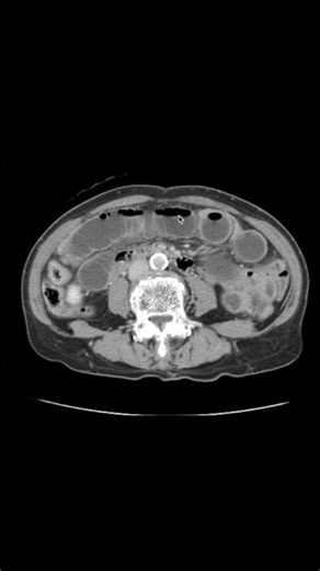 イレウスになった小腸のCT画像の見え方 #イレウス #CT #画像診断