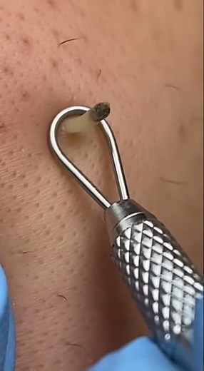 Massive Blackhead Extractions 😱 Deep Facial Treatment