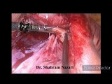 Laparoscopy in Acute Suppurative Appendicitis • Video • MEDtube.net