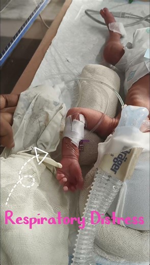 Baby on CPAP