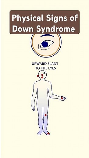 Physical features of Down Syndrome #downsyndrome #trisomy21 #biotechreview #learningbiology