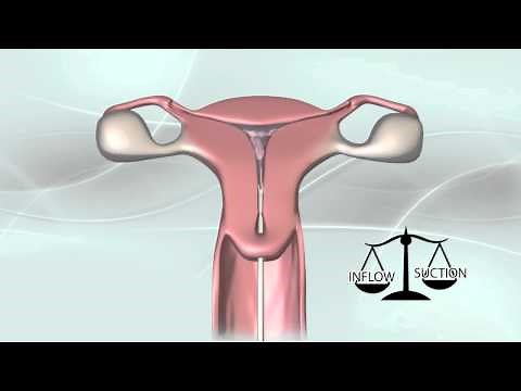 MyoSure tissue removal procedure animation