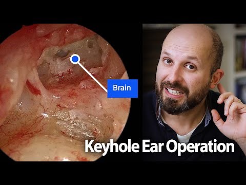 Watch an ear operation (mastoidectomy)