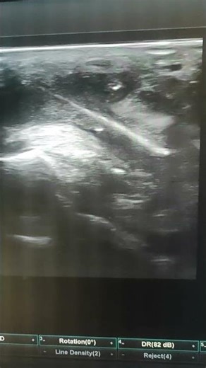 Foreign body in foot