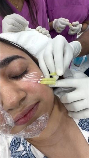 Smooth. Lift. Rejuvenate with PDO Mono Threads