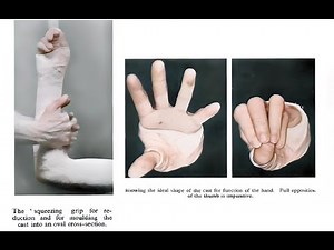 Technique of Closed Reduction (Radius and Ulna)