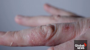 Chronic hand eczema symptoms and prevention during eczema awareness month