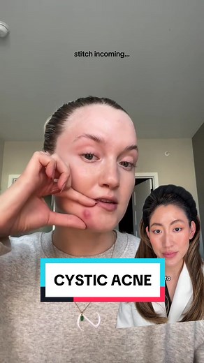Cystic Acne Journey: Treatment Tips and Advice