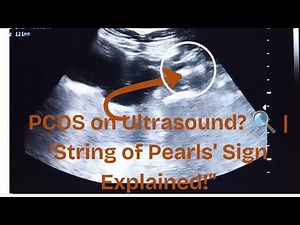 How to Diagnose Polycystic Ovaries on Pelvic Ultrasound | PCOS Ultrasound Criteria Explained