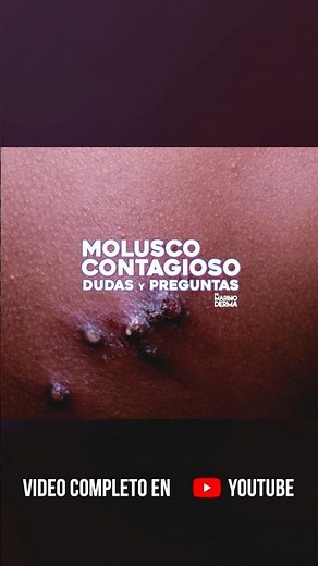 🤩MOLLUSCUM CONTAGIOSUM. QUESTIONS AND ANSWERS 🌟Don't miss the new video this Sunday at 7:15 pm!