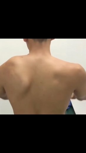Med_students0 on Instagram: "Winged Scapula from Long Throacic Nerve Injury The most common etiology of a winged scapula is usually due to damage or impaired innervation to the serratus anterior muscle."