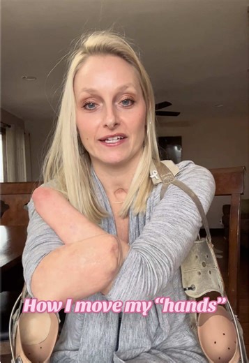 How Amputees Adapt to Life Without Hands