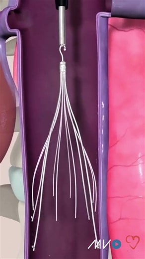 When is an IVC filter placed via the neck?