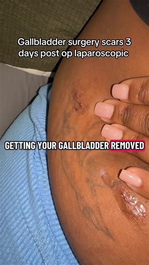 Gallbladder Surgery Journey: 3 Days Post-Op