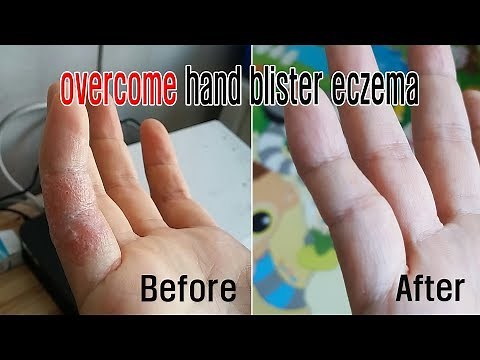 overcome hand blister ezema/dermatitis/How to save the hand blister ezema