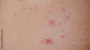 The classic symptom of chickenpox is a rash that turns into itchy, fluid-filled blisters.