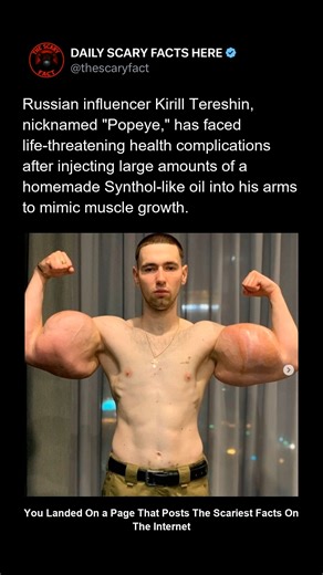 Thescaryfact ™ on Instagram: "Russian influencer Kirill Tereshin, nicknamed “Popeye,” gained viral attention after injecting large amounts of a homemade Synthol-like oil into his arms to imitate muscle growth. Over time, his arms became severely distorted. Medical professionals later warned that the injections caused life-thr!#&*eatening complications, including tissue damage, inflammation, and risk of am!#&*putation. Tereshin has since undergone multiple procedures, with doctors stating the dam