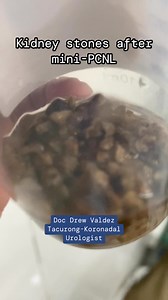 1.2M views · 3.8K reactions | Kidney stones after mini-PCNL | Doc Drew Valdez - Urology | Facebook