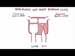 Hypoplastic left heart syndrome HLHS causes, symptoms & pathology
