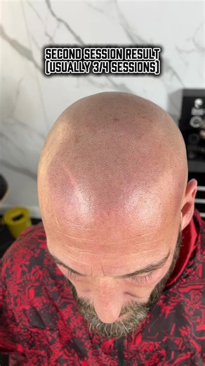 Considering SMP? Watch the Difference Between Session 1 & 2. Every client’s journey is unique, but one thing is consistent: the magic happens in stages. Here’s my client coming back fully healed from Session 1 open density, natural shade, and settled exactly the way it should. Then you’ll see Session 2, where we build density, refine the hairline, and create that crisp, realistic finish. This process isn’t rushed. It’s precision, patience, and properly spaced sessions that deliver long-lasting, 