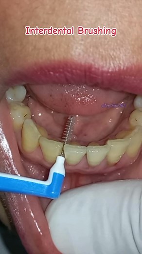 Effective Interdental Brushing Techniques for Oral Health